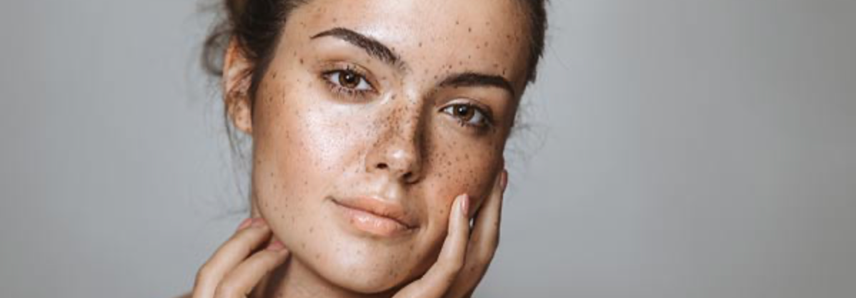 Hyperpigmentation/Melasma